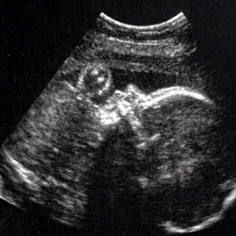 sonogram picture of healthy baby